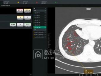 韩国AI医疗横扫欧洲！Coreline Soft包揽法国国家级肺癌筛查项目