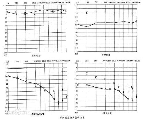 听力曲线.jpg