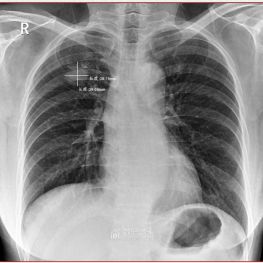 体检DR常规胸片检出了右上肺类圆形结节代表什么